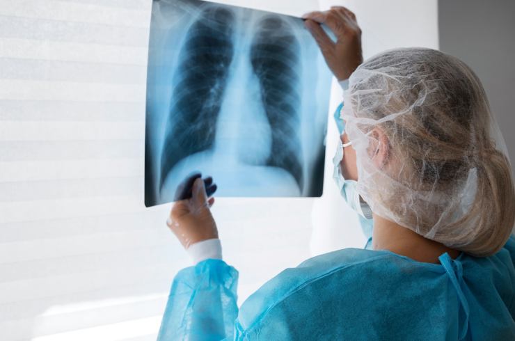 Bronchiectasis
